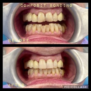 Composite Bonding
