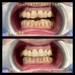 Composite Bonding
