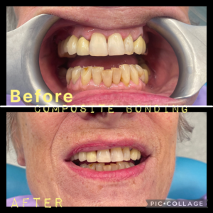 Composite Bonding
