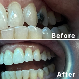 Upper left Premolar Composite