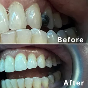 Upper left Premolar Composite